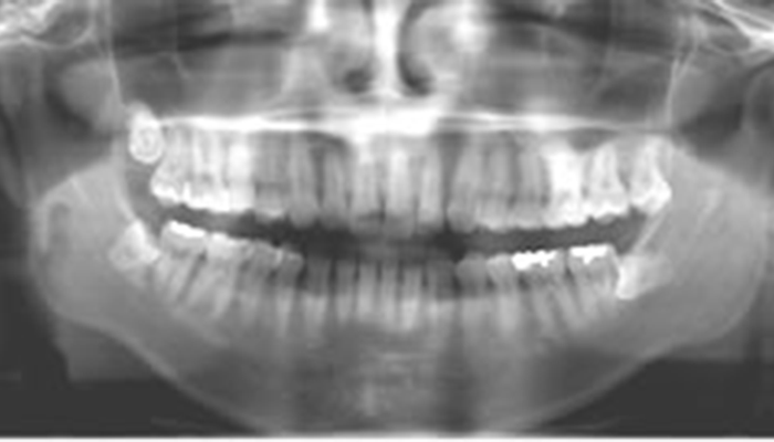 従来のパノラマレントゲン画像