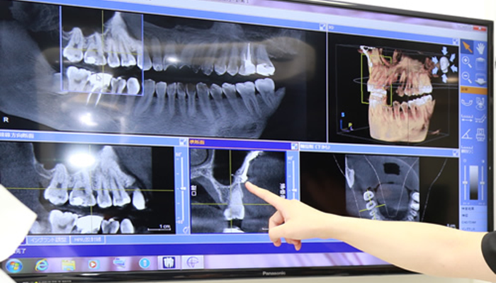 精密インプラント治療